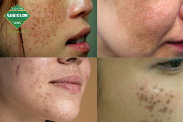 Điều trị sắc tố da tại Phòng Khám da liễu thẩm mỹ Thiên Vân
