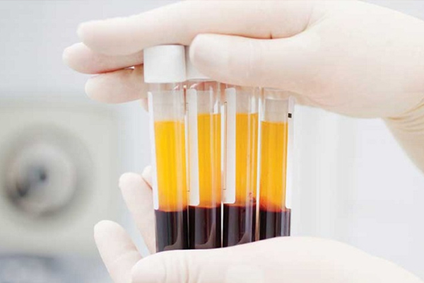 PRP - Huyết tương giàu tiểu cầu