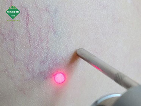 Điều trị suy giãn tĩnh mạch bằng phương pháp laser mạch máu