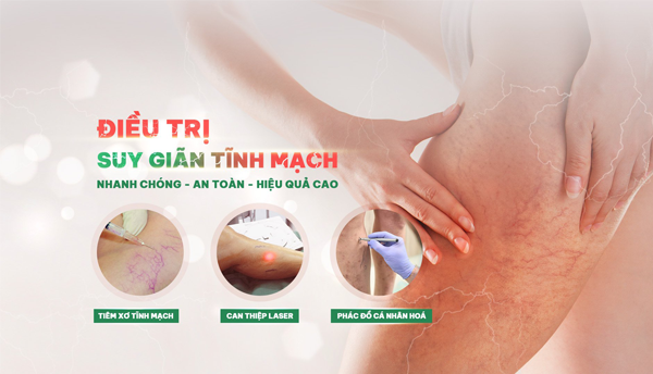 Phương pháp điều trị suy giãn tĩnh mạch tại Thiên Vân