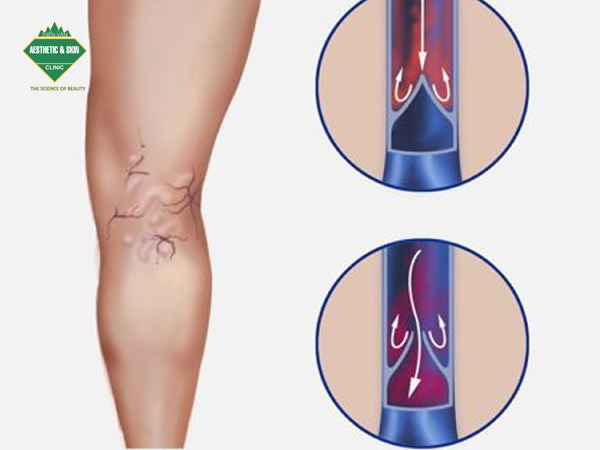 Hiện tượng máu ứ đọng sẽ gây ra những biến đổi về huyết động và tổ chức mô xung quanh