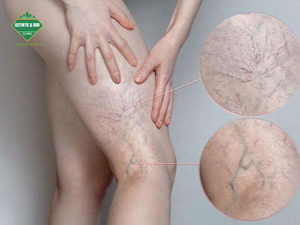 Các dấu hiệu suy giãn tĩnh mạch thường gặp