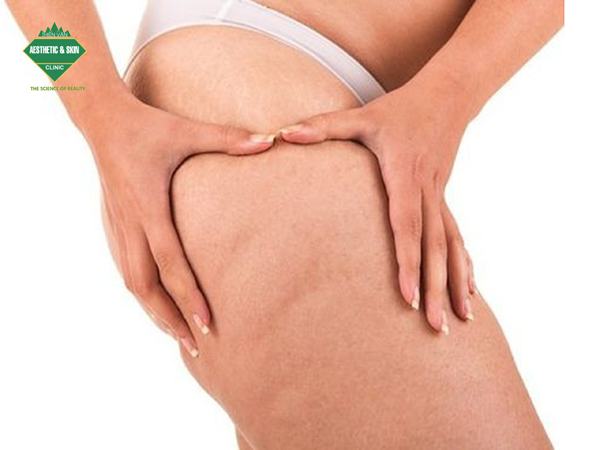 Hiện tượng da sần vỏ cam