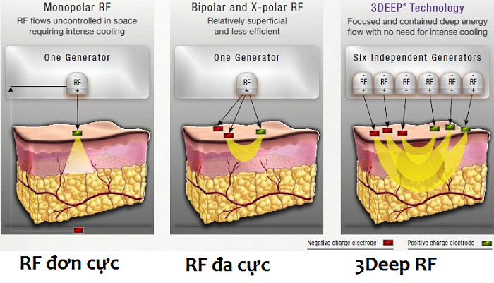 So sánh giữa 3DEEP RF, RF đơn cực và RF lưỡng cực