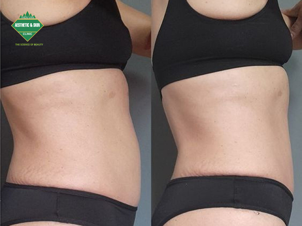Kết quả trước và sau điều trị