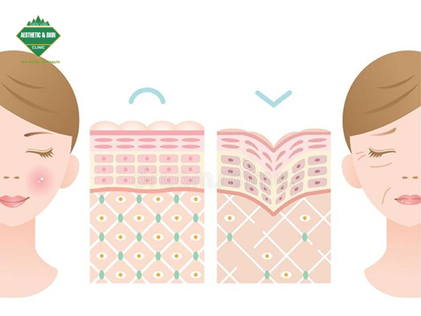 HIFU kích thích tăng sinh collagen làm đầy nếp nhăn