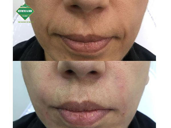 Khách hàng trước và sau nâng cơ trẻ hoá HIFU