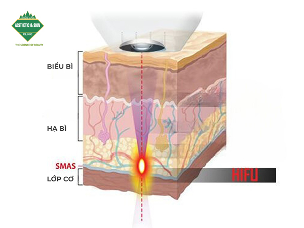 HIFU tác động sâu đến lớp cơ dưới da