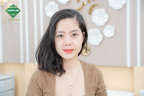 Khách hàng sau điều trị tái tạo bề mặt, trẻ hoá da với Laser CO2