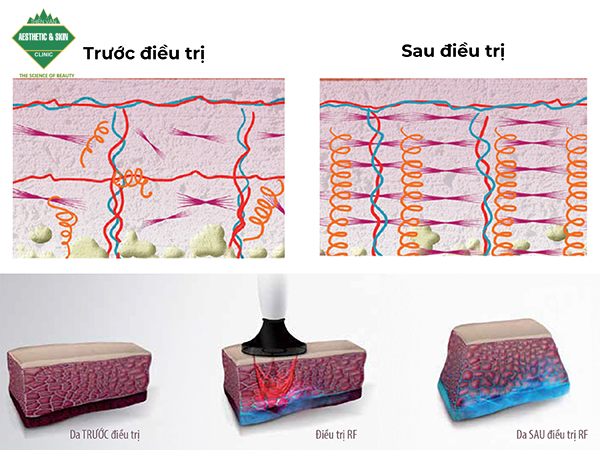 Da trước và sau khi điều trị RF