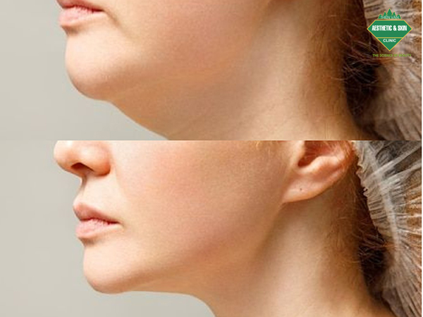 Kết quả trước và sau thon gọn nọng, cổ