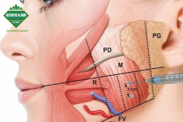 Vị trí tiêm gọn mặt tại cơ nhai