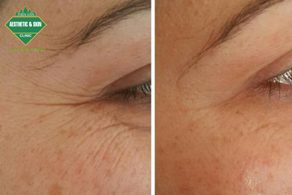 Khách hàng tiêm botox xóa nhăn vùng mắt